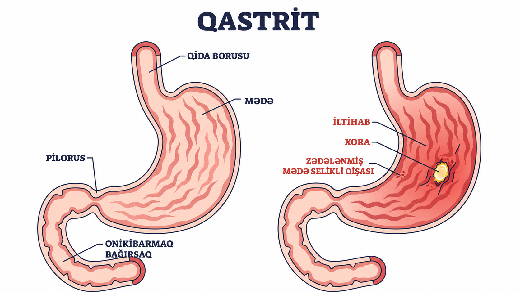 Reflu ve gastrit ferqi — mede agrisi mede yanmasi elametleri mualice pehriz